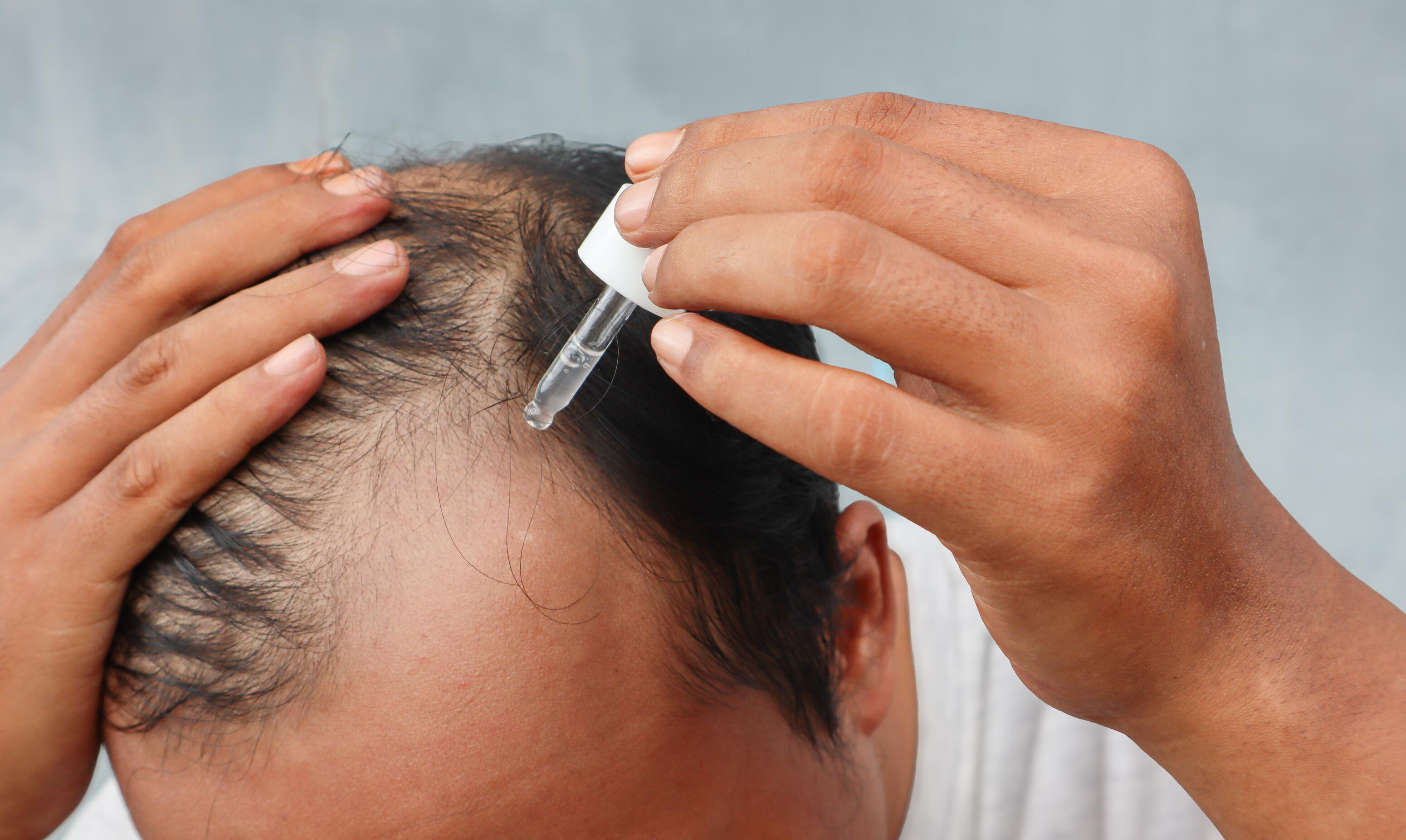 Eine Person trägt mit einer Pipette ein Haarserum gezielt auf eine sichtbare kahle Stelle am Oberkopf auf.